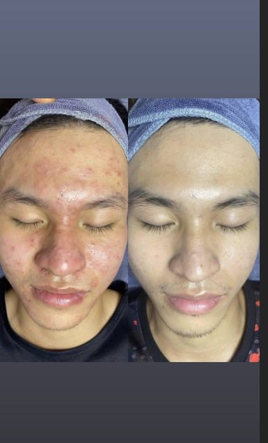 Skin Treatment image 78 at DIVA Skin Clinic Poipet